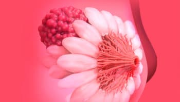 Alertan en EU por posible cáncer de piel en cicatrices de implantes mamarios