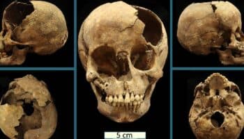 Bacteria causante de la sífilis se manifestó en América antes de la llegada de Colón