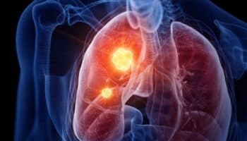 México registra más de 7 mil 500 casos nuevos de cáncer de pulmón cada año: OMS
