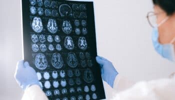 Alzheimer puede transmitirse por accidentes médicos, advierte estudio