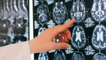 Asocian dos químicos habituales en los hogares al desarrollo de enfermedades cerebrales