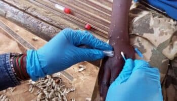 Unicef solicita 16.5 millones de dólares para combatir la mpox en África