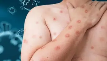 ¿Por qué las vacunas contra la mpox están tardando tanto en llegar a África?