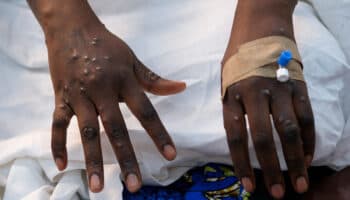 Mpox: OMS da luz verde a la vacuna de Bavarian Nordic