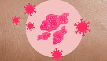 Herpes Zóster: ¿Cuál es el mejor método para prevenirlo?