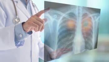 INER usará IA para identificar cáncer de pulmón en etapa temprana