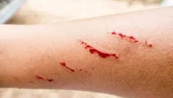 Zacatecas | Adolescente recibe atención por posible rabia tras mordida de zorrillo